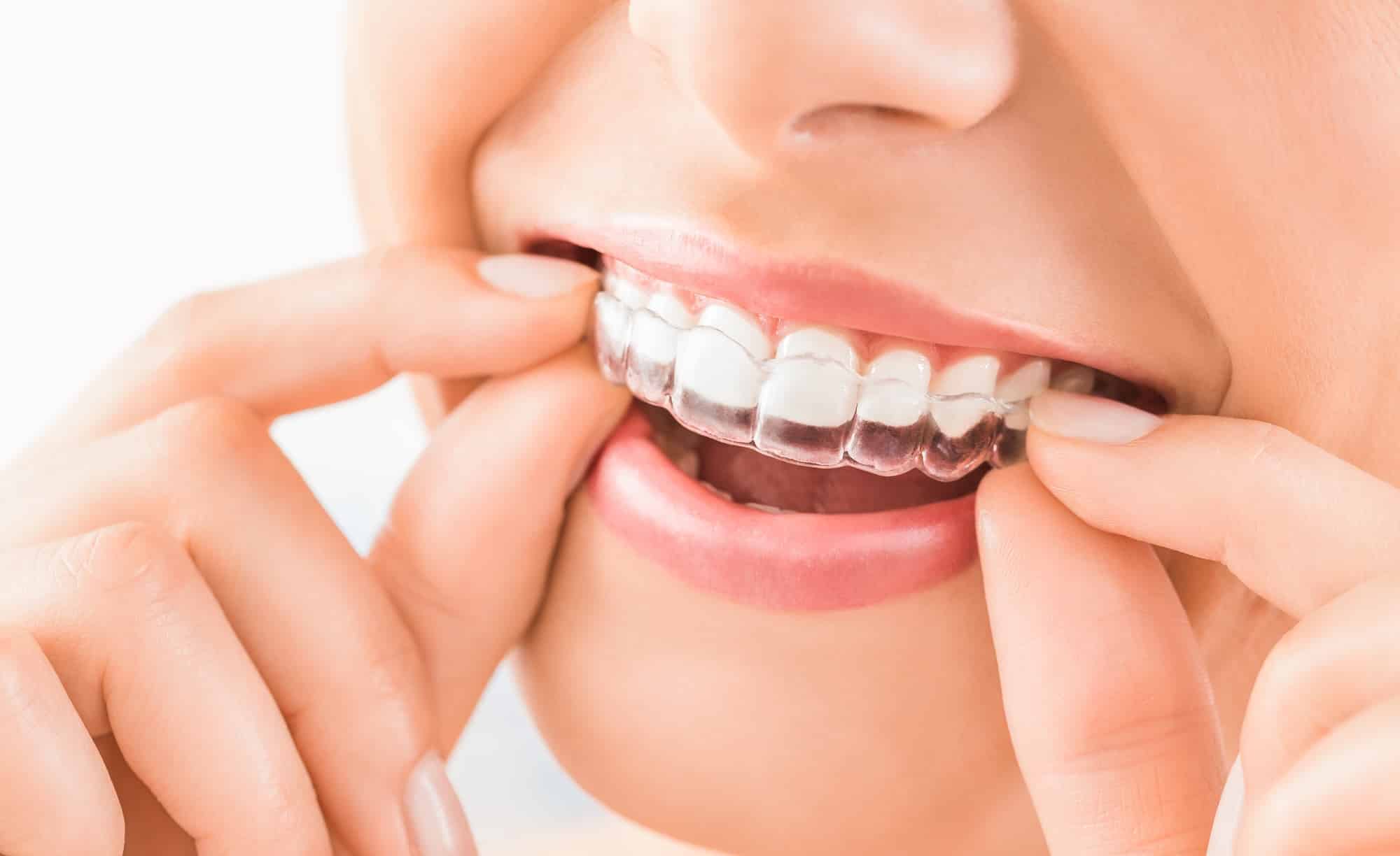 A close-up of a person’s mouth showing clear orthodontic aligners being placed on their teeth. The individual is using both hands to position the aligners securely, with a focus on their smile and dental care.